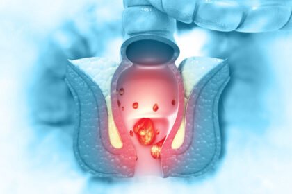 Hemorroidas são protuberâncias que se formam no interior ou ao redor do ânus devido ao aumento dos vasos sanguíneos