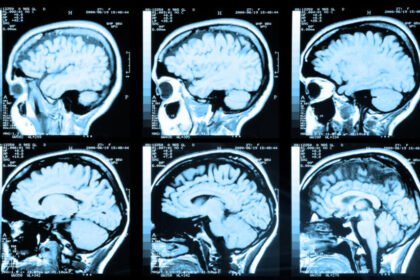 Medicamento para HIV poderia tratar ou prevenir Alzheimer, indica estudo