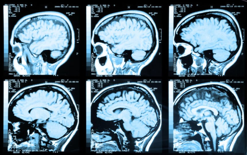 Medicamento para HIV poderia tratar ou prevenir Alzheimer, indica estudo