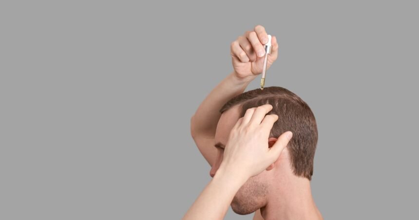 Minoxidil pode levar bebês à ‘síndrome de lobisomem’; entenda